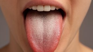 lepedékes nyelv szép női száj