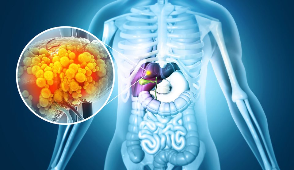 Súlyos problémát jelenthet a zsírmáj | Meglepetés Zsírmáj