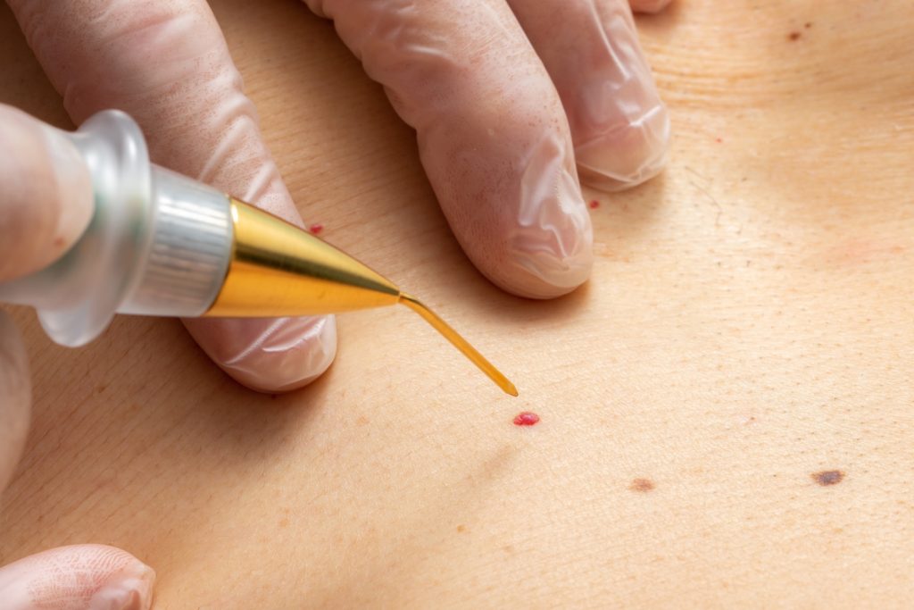cseresznye-angioma1 | Meglepetés cseresznye-angioma nő hátán piros pötty