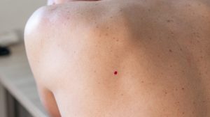 cseresznye-angioma nő hátán piros pötty