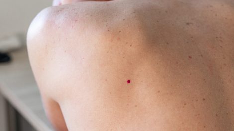 cseresznye-angioma nő hátán piros pötty