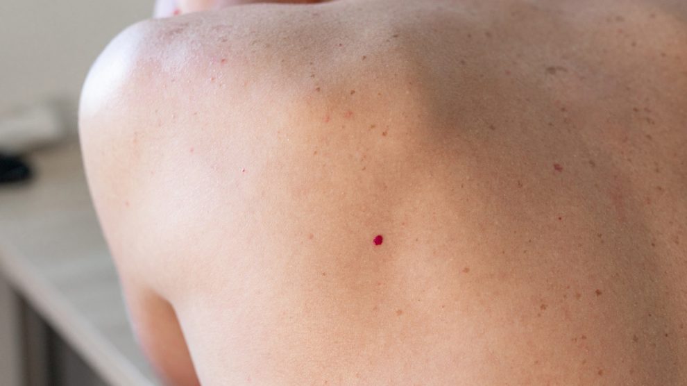 cseresznye-angioma nő hátán piros pötty
