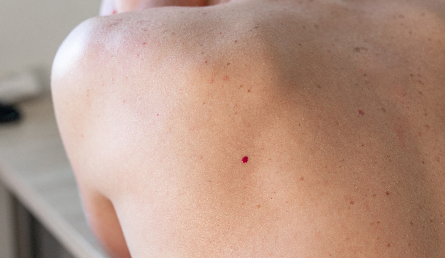 cseresznye-angioma nő hátán piros pötty