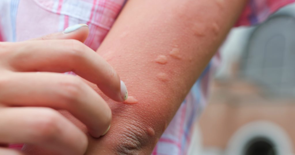 Arm of gilr is bitten by the mosquito and get bumps on her skin in the summer | Meglepetés sok szúnyogcsípés egy nő karján