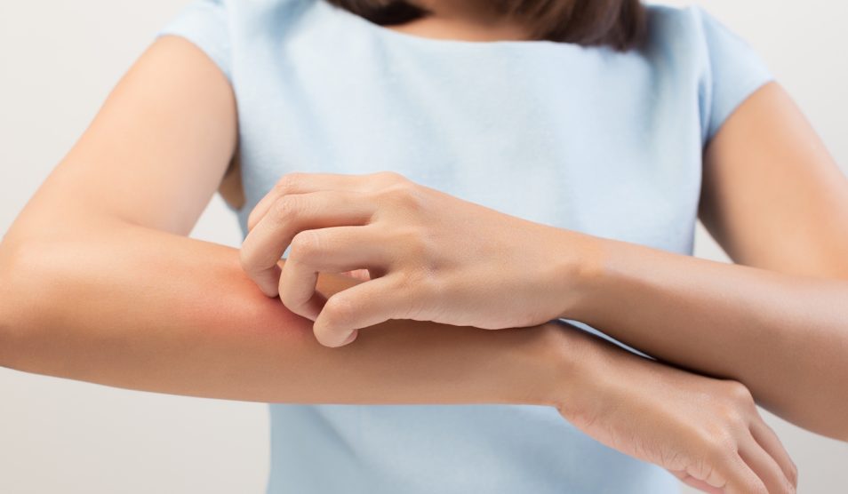 Itching In A Woman | Meglepetés szúnyogcsípést vakaró nő