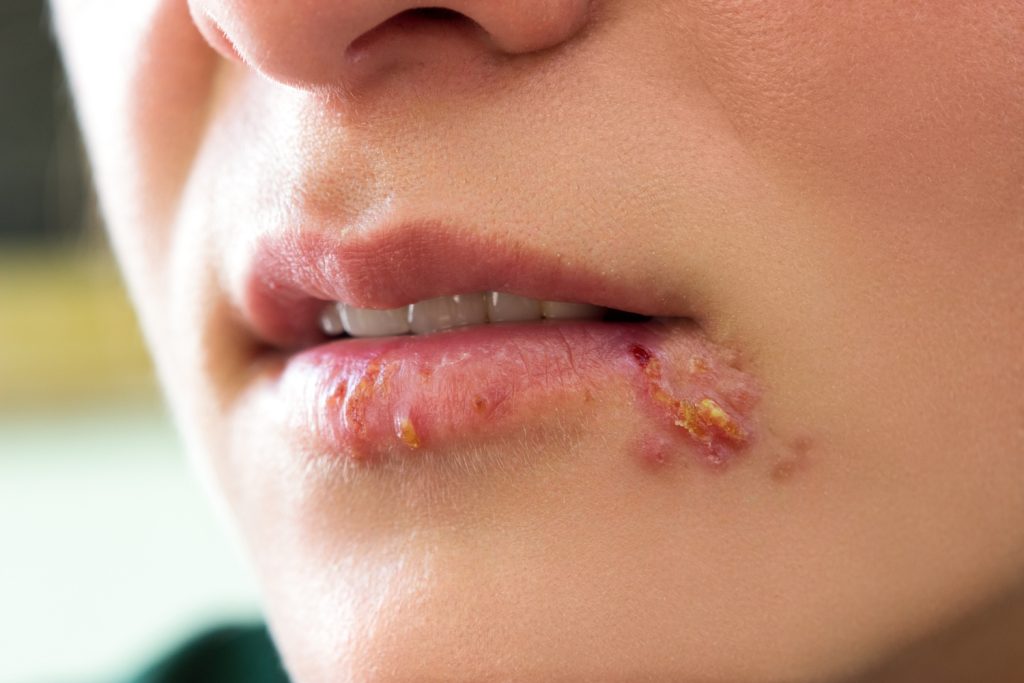 Girl lips showing herpes blisters | Meglepetés Herpeszes hólyagok egy fiatal nő ajkán